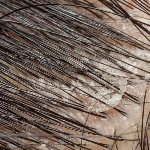 dandruff