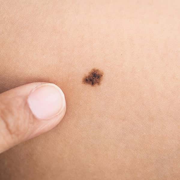 Skin_Cancer_Article_1