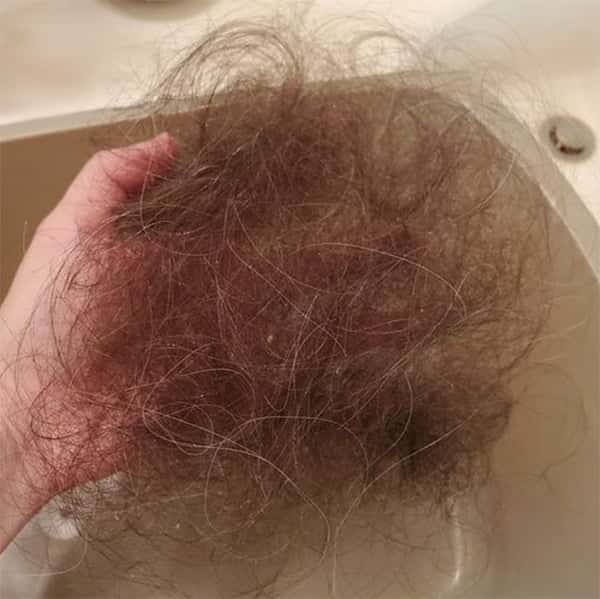 covid 19 coronavirus hair loss