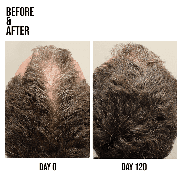 evolis_FB_Live_Hair_Loss_1