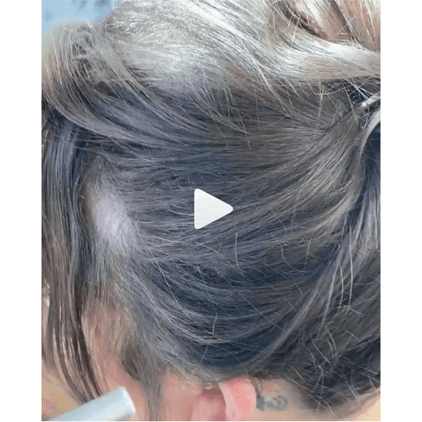 Xfusion_Hairloss_1