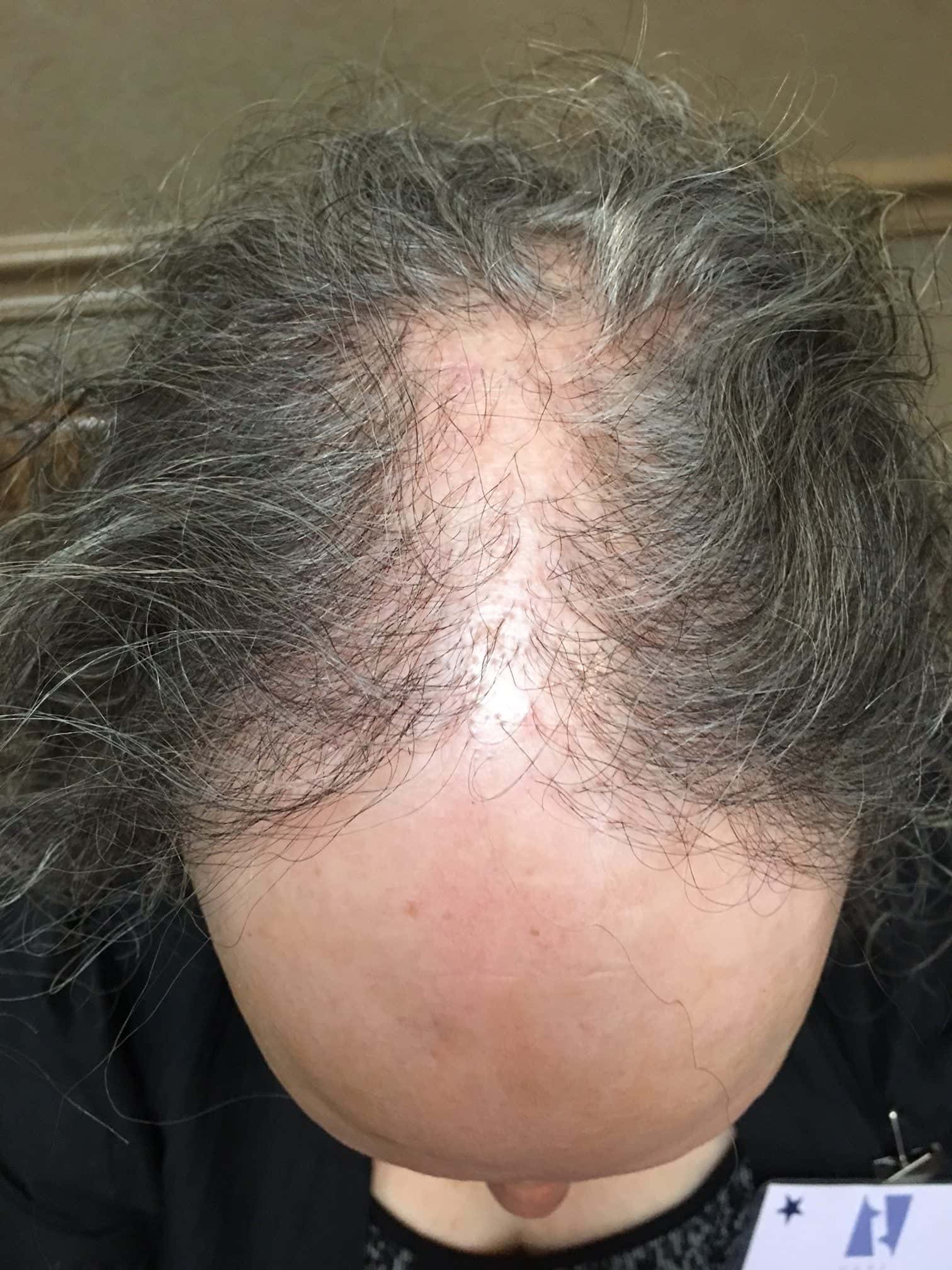 navigating-hair-loss-article