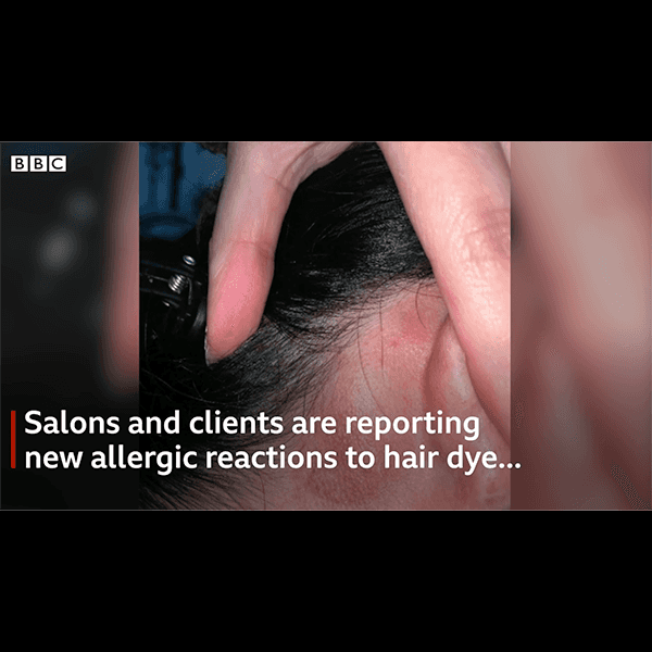 allergic reaction rash from hair color after having COVID-19
