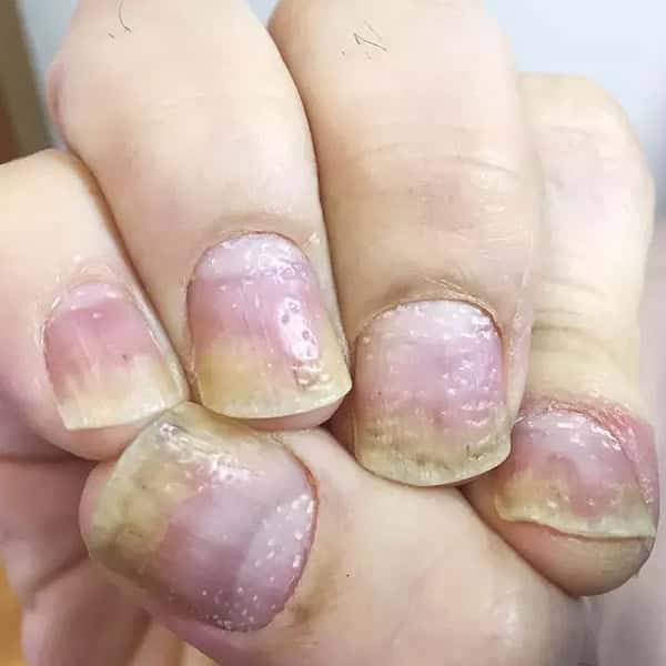 nejm-nail-pitting-feat-image-article