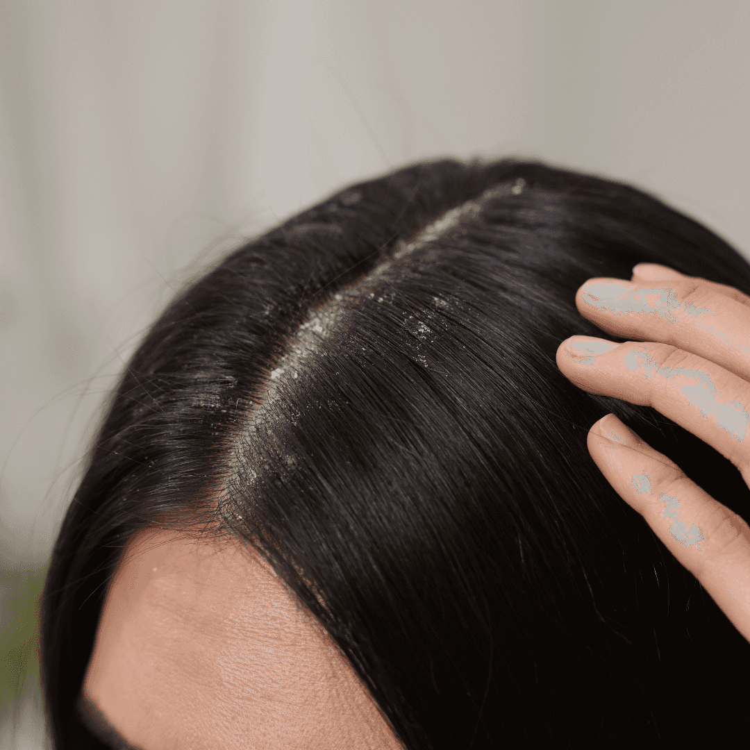 what is a moldy scalp