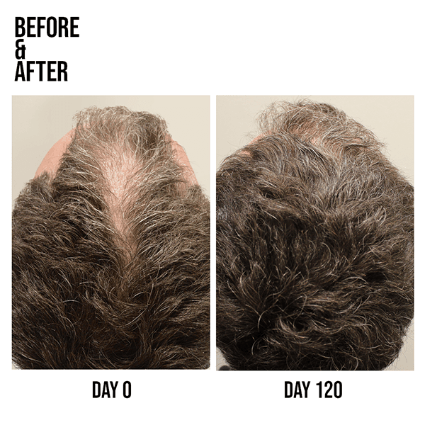 evolis_FB_Live_Hair_Loss_1
