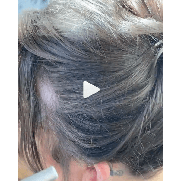 Xfusion_Hairloss_1