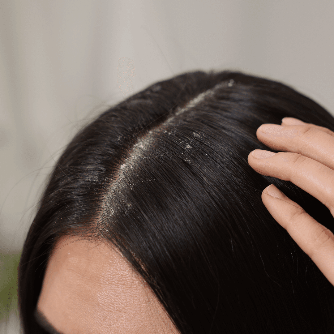 what is a moldy scalp