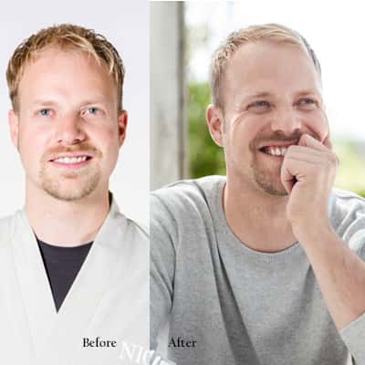 Nioxin- Before:After solution to thinning hair