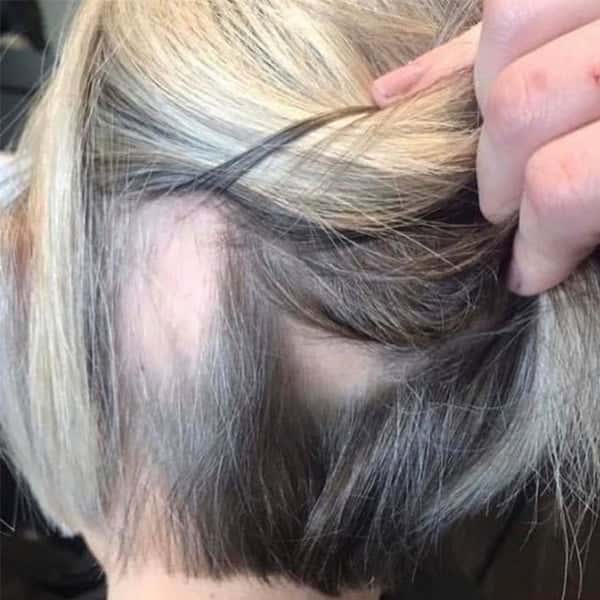what causes hair loss and thinning and surface awaken scalp facial for visible hair growth