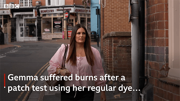 UK woman had an allergic reaction to haircolor after having COVID-19